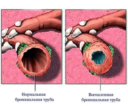 Бронхіт курця симптоми і лікування народними засобами