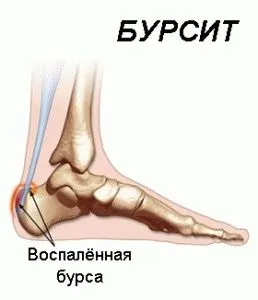 Бурсит п'яти причини, симптоми і лікування