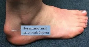 Бурсит п'яти причини, симптоми і лікування