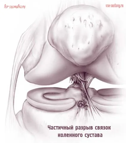 Частковий розрив зв'язок колінного суглоба (суглоба) Частковий розрив зв'язок колінного суглоба