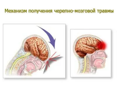 Черепно мозкова травма, черепно-мозкова травма, ЧМТ, струс мозку лікування в Благовєщенську (мозкова) Черепно мозкова травма, черепно-мозкова травма, ЧМТ, струс мозку лікування в Благовєщенську