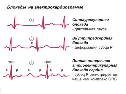 Чим небезпечна блокада серця - наслідки різного ступеня (небезпечна) Чим небезпечна блокада серця - наслідки різного ступеня