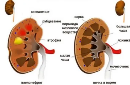 Що робити щоб розсмокталася кіста на нирці (нирці) Що робити щоб розсмокталася кіста на нирці