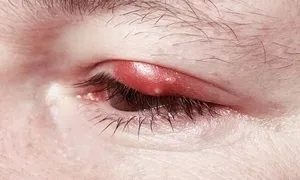 Що робити при запаленні очей захворювання, що викликають запалення і почервоніння очей, симптоми і (очей) Що робити при запаленні очей захворювання, що викликають запалення і почервоніння очей, симптоми і