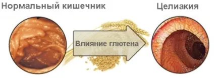 Що можна їсти при целіакію правила харчування і Безглютенові меню (харчування) Що можна їсти при целіакію правила харчування і Безглютенові меню