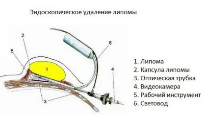 Що це таке ліпома і як її лікувати, причини виникнення жировик