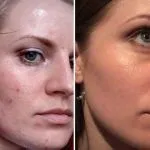 Що таке jet peel (газорідинний пілінг) протипоказання, ціни