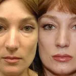 Що таке jet peel (газорідинний пілінг) протипоказання, ціни