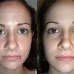Що таке jet peel (газорідинний пілінг) протипоказання, ціни