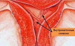 Що таке атрофія ендометрія (спостерігається важка форма) Що таке атрофія ендометрію