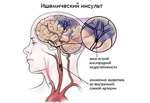Що таке актовегина - інструкція із застосування і особливості (основного компонента поліпшується) Що таке актовегина - інструкція із застосування і особливості