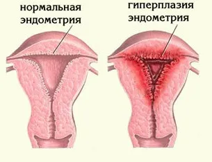 Що таке атрофія ендометрія (атрофія) Що таке атрофія ендометрію