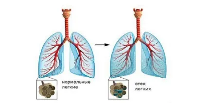 Серцевий кашель симптоми, лікування і що це таке (симптоми) Серцевий кашель симптоми, лікування і що це таке