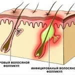 Що таке стафилодермия - форми і види, причини, симптоми, лікування (види) Що таке стафилодермия - форми і види, причини, симптоми, лікування