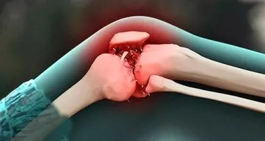Що таке остеофіти і як їх лікувати