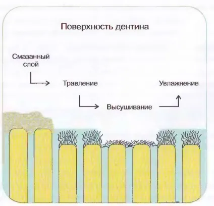 Десенсітайзери (desensitizer) в стоматології види, дія, кращі препарати (десенсітайзери) Десенсітайзери (desensitizer) в стоматології види, дія, кращі препарати