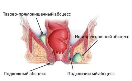 Дістрептаза свічки - опис препарату і інструкція із застосування - my life