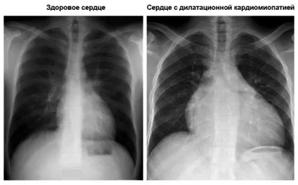 Дилатаційна кардіоміопатія що це таке, причини, симптоми і лікування (таке) Дилатаційна кардіоміопатія що це таке, причини, симптоми і лікування