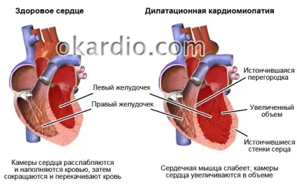 Дилатаційна кардіоміопатія що це таке, причини, симптоми і лікування (причини) Дилатаційна кардіоміопатія що це таке, причини, симптоми і лікування