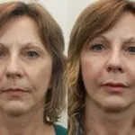 Чи ефективний липофилинг сідниць, шкіри обличчя, грудних залоз і інших частин тіла, як він проводиться і (залоз) Чи ефективний липофилинг сідниць, шкіри обличчя, грудних залоз і інших частин тіла, як він проводиться і