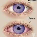 Двоїння в очах причини і способи лікування - лікування очей на дому