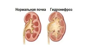 Ефективні методи лікування гідронефрозу нирки народними засобами