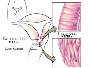 Ерозія шийки матки наслідки захворювання, чим небезпечна ерозія (наслідки) Ерозія шийки матки наслідки захворювання, чим небезпечна ерозія