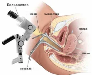 Ерозія шийки матки наслідки захворювання, чим небезпечна ерозія (матки) Ерозія шийки матки наслідки захворювання, чим небезпечна ерозія