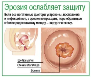 Ерозія шийки матки наслідки захворювання, чим небезпечна ерозія (матки) Ерозія шийки матки наслідки захворювання, чим небезпечна ерозія