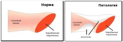 Екзостоз зовнішнього слухового проходу причини, діагностика, лікування (екзостоз зовнішнього слухового проходу) Екзостоз зовнішнього слухового проходу причини, діагностика, лікування