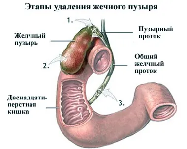 Якщо видалений жовчний міхур - поради для жінок онлайн (кишку) Якщо видалений жовчний міхур - поради для жінок онлайн