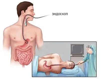 Езофагогастродуоденоскопія і гастроскопія в чому різниця, підготовка, протипоказання (езофагогастродуоденоскопія) Езофагогастродуоденоскопія і гастроскопія в чому різниця, підготовка, протипоказання