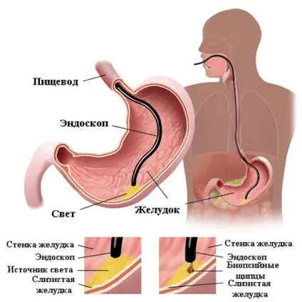 Езофагогастродуоденоскопія і гастроскопія в чому різниця, підготовка, протипоказання (езофагогастродуоденоскопія і гастроскопія) Езофагогастродуоденоскопія і гастроскопія в чому різниця, підготовка, протипоказання