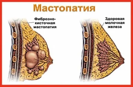 Фіброматозні вузли та їх лікування