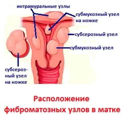 Фіброматозні вузли та їх лікування