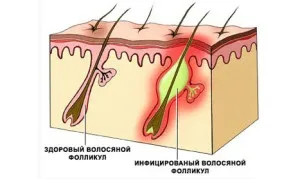 Фолікуліт голови причини, симптоми, лікування (волосистої частини голови) Фолікуліт голови причини, симптоми, лікування