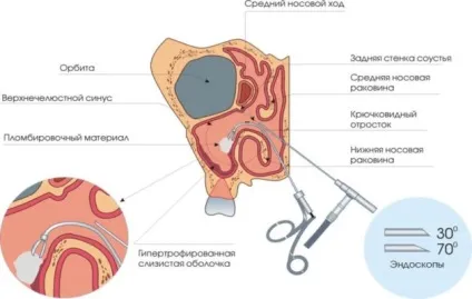 Гайморит операція як останній шанс на одужання (гайморит) Гайморит операція як останній шанс на одужання