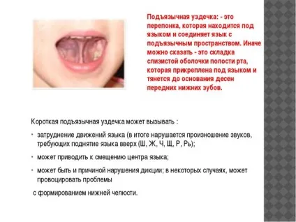 Френулопластика що це таке і як проводиться процедура (процедура) Френулопластика що це таке і як проводиться процедура