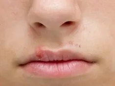 Герпес на губах як позбутися від застуди на обличчі, все про здоров'я, секс і відносинах (позбутися) Герпес на губах як позбутися від застуди на обличчі, все про здоров'я, секс і відносинах
