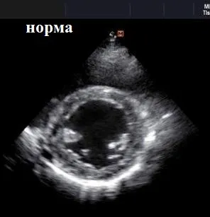 Гіпертрофія лівого шлуночка причини, механізм, наслідки (причини) Гіпертрофія лівого шлуночка причини, механізм, наслідки