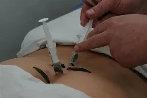 Гірудотерапія кому показана, ціна сеансу і його ефекти (сеансу) Гірудотерапія кому показана, ціна сеансу і його ефекти