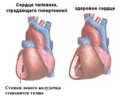 Гіпертрофія лівого шлуночка причини, механізм, наслідки (лівого) Гіпертрофія лівого шлуночка причини, механізм, наслідки