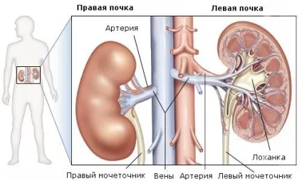 Гідронефроз нирки лікування народними засобами, причини виникнення, симптоми (гідронефроз) Гідронефроз нирки лікування народними засобами, причини виникнення, симптоми