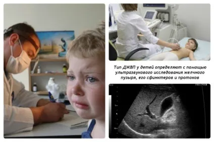 Гіпертонічна дискінезія жовчовивідних шляхів (гіпертонічна) Гіпертонічна дискінезія жовчовивідних шляхів