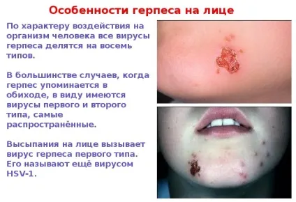 Герпес на обличчі - фото симптомів на різних стадіях (фото) Герпес на обличчі - фото симптомів на різних стадіях