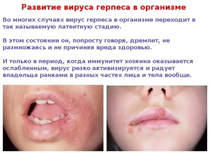 Герпес на обличчі - фото симптомів на різних стадіях (різних) Герпес на обличчі - фото симптомів на різних стадіях