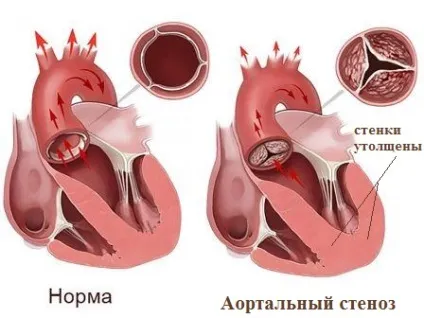 Гіпертрофія лівого шлуночка причини, механізм, наслідки (причини) Гіпертрофія лівого шлуночка причини, механізм, наслідки