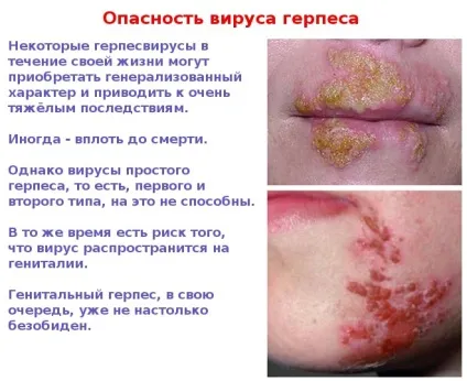 Герпес на обличчі - фото симптомів на різних стадіях (герпес) Герпес на обличчі - фото симптомів на різних стадіях