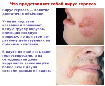 Герпес на обличчі - фото симптомів на різних стадіях (герпес) Герпес на обличчі - фото симптомів на різних стадіях