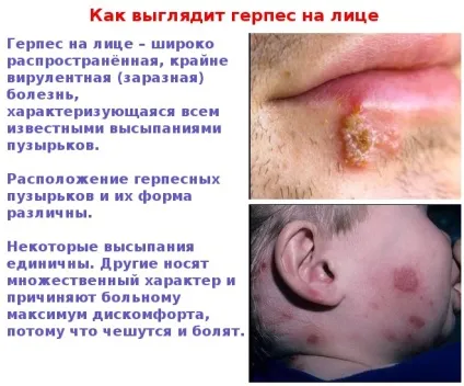Герпес на обличчі - фото симптомів на різних стадіях (фото) Герпес на обличчі - фото симптомів на різних стадіях